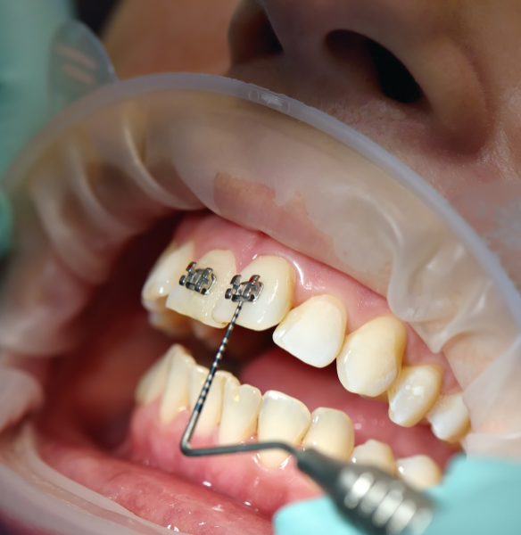 Accelerated Orthodontics